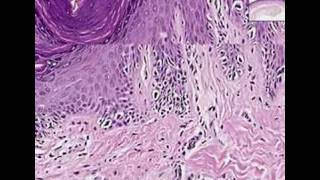Histopathology Skin--Melanoma in situ