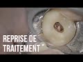 Tuto endo  reprise de traitement dune dent obture au thermafil