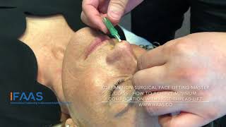 How to insert Nose Threadlift into the proper position to minimise complication rate?