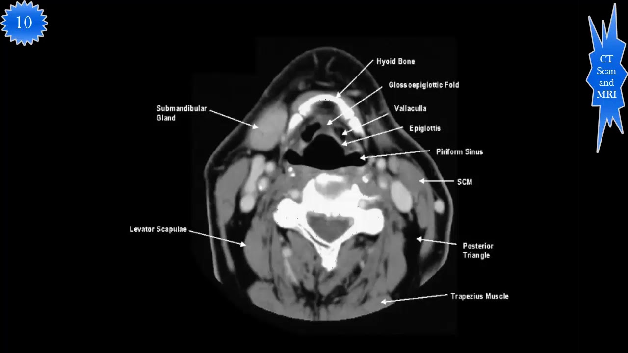 Ct Scan Of Neck Study Part Youtube