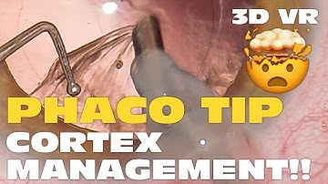 3D Phaco Clip #135 - Phaco Tip Cortex Management (VR Headset version)