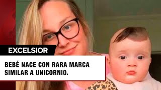 Bebé nace con rara marca que la hace lucir como un adorable unicornio