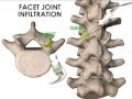 Ultrasound guided facet joint and medial branch infiltration