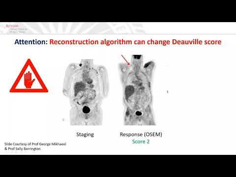 Evolution of Radiation in Hodgkin Lymphoma_Dr Rahul R.  Parikh, MD