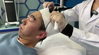 Picosecond laser tattoo removal machine treatment and operation video PS300