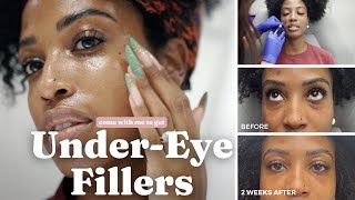 I Got Under Eye Fillers | Before, After, and During | Very Detailed