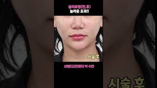 실리프팅(전,후) 놀라운 효과!? #올리고당 #실리프팅#박수연원장