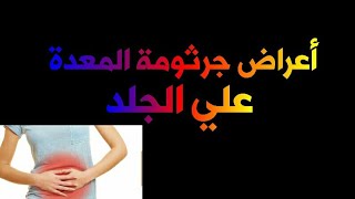 أعراض جرثومة المعدة علي الجلد