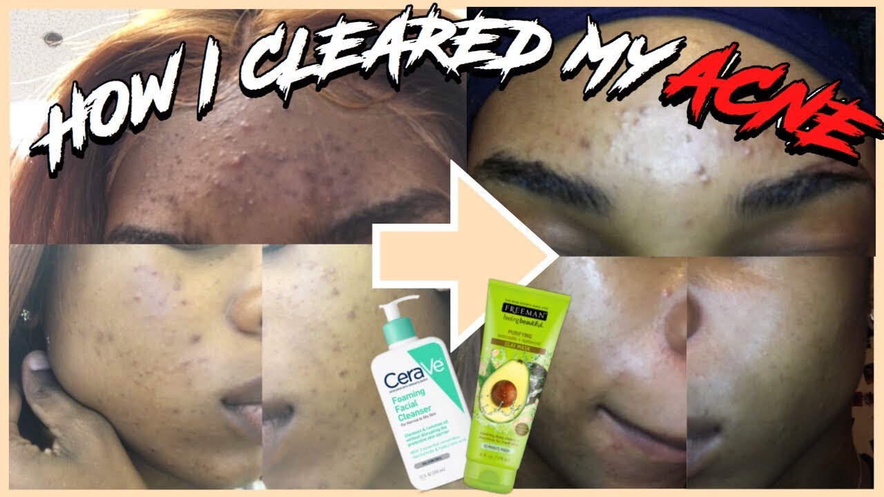 HOW I CLEARED MY ACNE + MY DAILY SKIN ROUTINE - YouTube