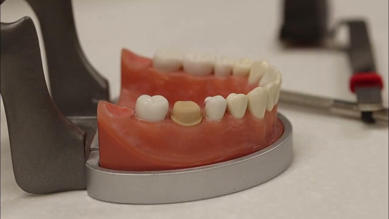 Zirconia Crown Chairside Adjustment and Polishing on a Typodont YouTube