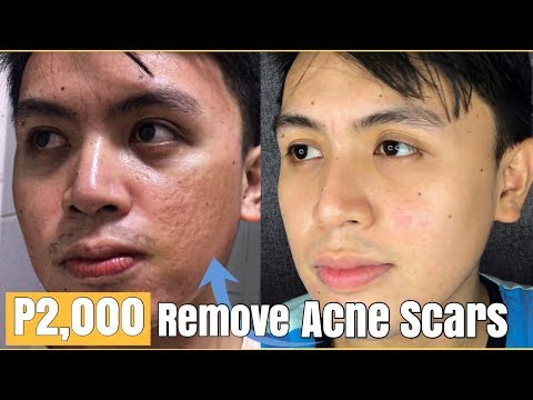 HOW TO REMOVE ACNE SCARS | P2,000 FRACTIONAL LASER |PAANO KUMINIS