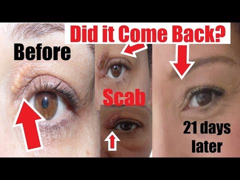 Has My Xanthelasma Come Back? Before & After Xanthelasma Removal at Home