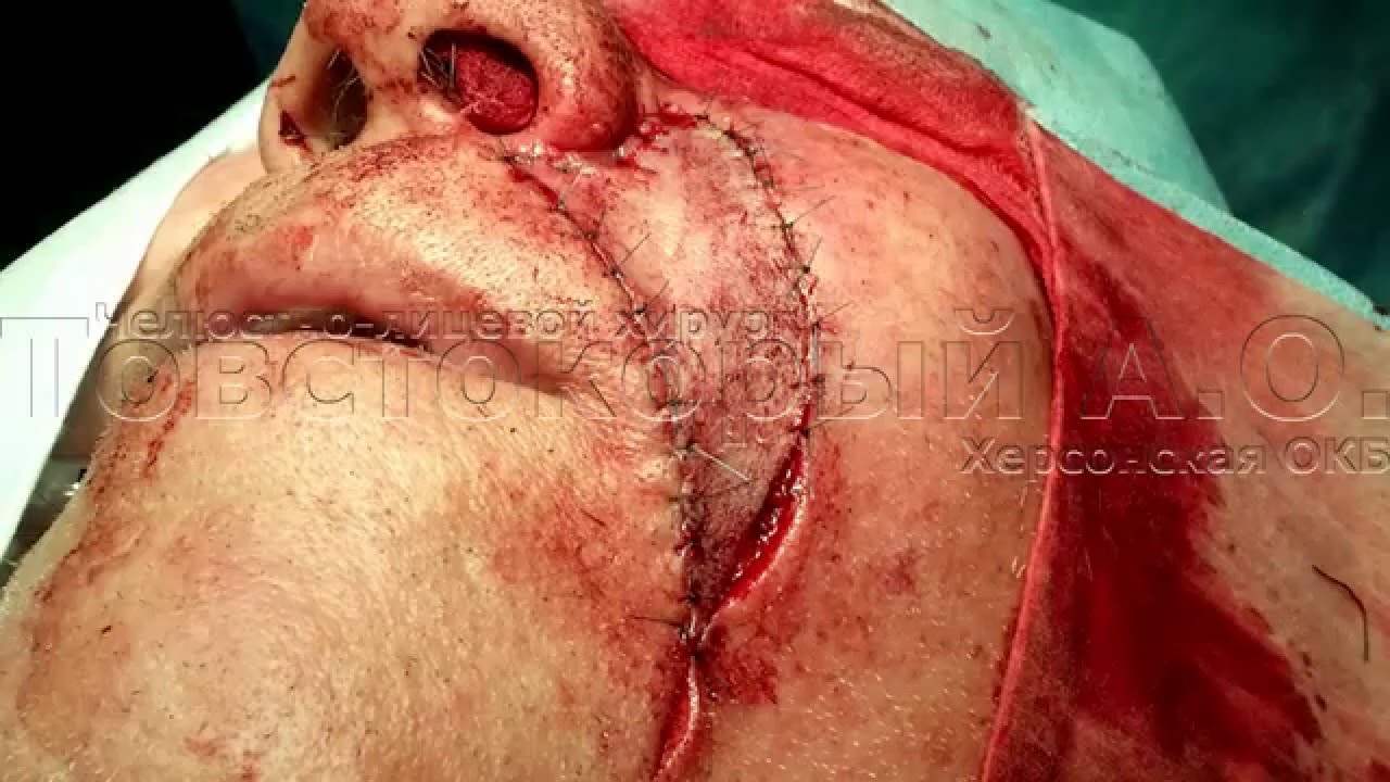 Удаление базалиомы в области носогубной складки с пластикой местными тканями.