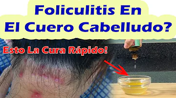 ¿Cómo deshacerse de la foliculitis del cuero cabelludo de forma permanente?