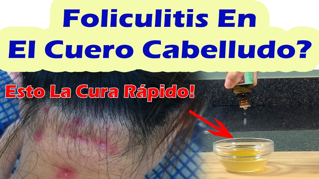 Esto Cura La Foliculitis Del Cuero Cabelludo Rápidamente