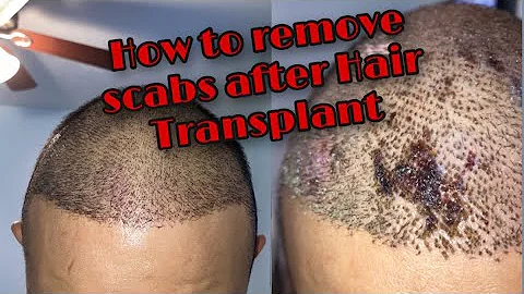Wie man Krusten nach einer Haartransplantation schonend entfernt