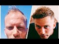 Capture de la vidéo 1 Year Hair Transplant Timeline - Day 0 To 365