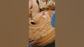 Migraines - Brain Structure That Can Cause the Pain