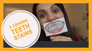 WHAT CAUSES TEETH STAINS ? HOW TO GET RID OF TEETH STAINS ?