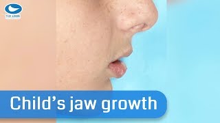 Will my child&#39;s jaw grow?