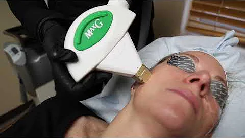 Courtney IPL Photofacial | Aesthetica Cosmetic & L...
