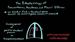 The Fundamentals of Chest Tube Physiology for Learners on a Surgery Rotation