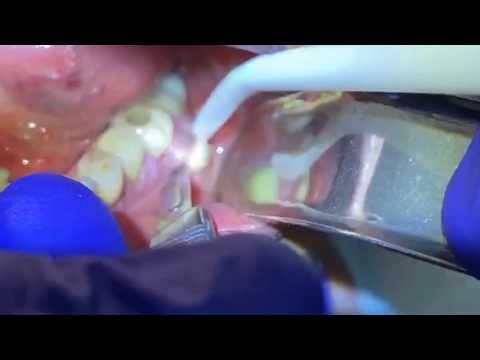 Draining a Dental Abscess | Advanced Dental Care