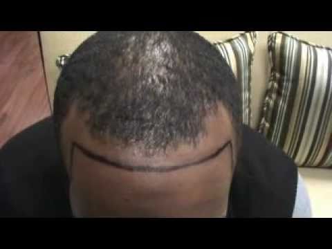 HAIR LOSS TATTOO Testimonial - MARCUS