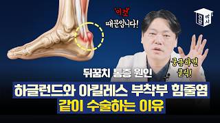 뒤꿈치 통증 원인 하글런드와 아킬레스 부착부 힘줄염 같이 수술하는 이유 #뒤꿈치통증
