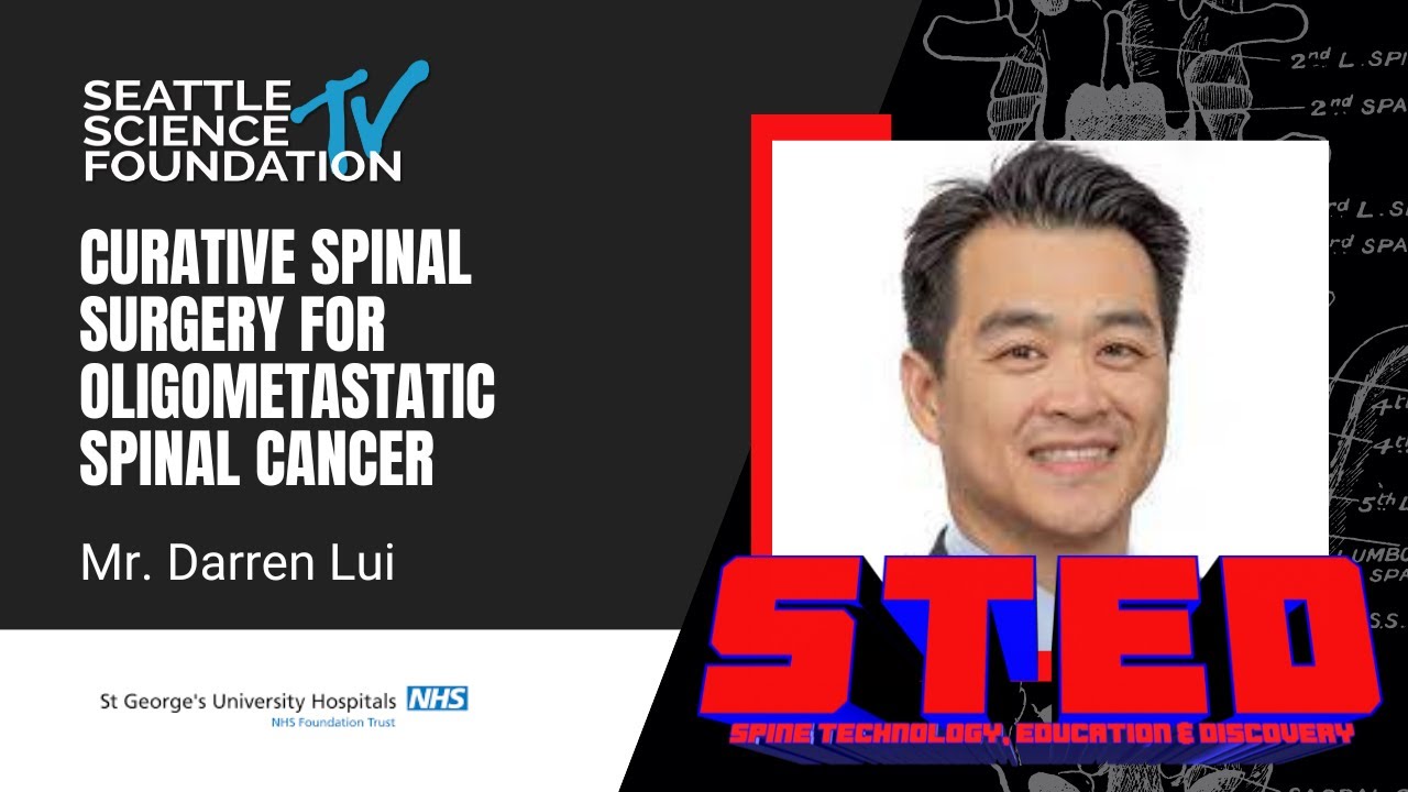 Curative Spinal Surgery for Oligometastatic Spinal Cancer – Mr. Darren Lui