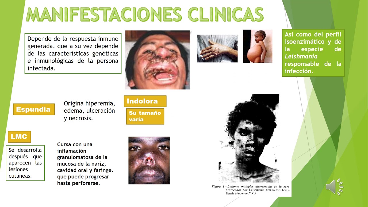 Leishmania braziliensis