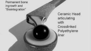 Hip Replacement: Hip Replacement Materials