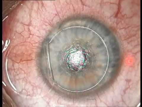 Blade Free LASIK with the Carl Zeiss Meditec VisuMax Femtosecond Laser and MEL 80 Excimer Laser