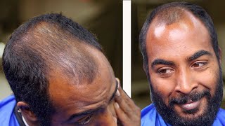WARNING - A Solution to GOING BALD 💯 His Wife did not recognize him