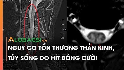 Nguy cơ tổn thương thần kinh, tủy sống do hít bóng cười