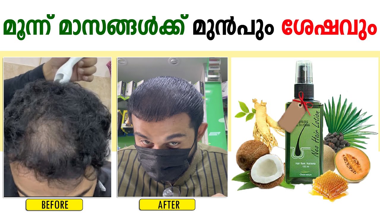 NEO HAIR LOTION BEFORE AND AFTER NEO HAIR LOTION MALAYALAM THREE