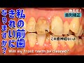【歯列矯正】神経ない歯は動かない！？神経なくてもきれいな歯に！