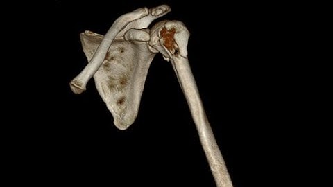 Proximal humerus fracture : 3 part fracture