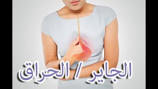 الجاير / الحراق | Le Reflux gastrique