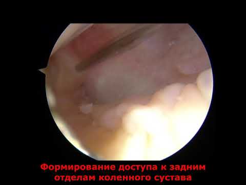 Реконструкция задней крестообразной связки (ЗКС)