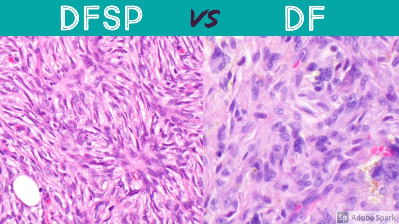 Dfsp Vs Df Dermatofibrosarcoma Protuberans Vs Dermatofibroma