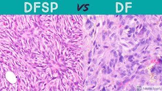 DFSP vs DF (dermatofibrosarcoma protuberans vs dermatofibroma): pathology dermatology dermpath