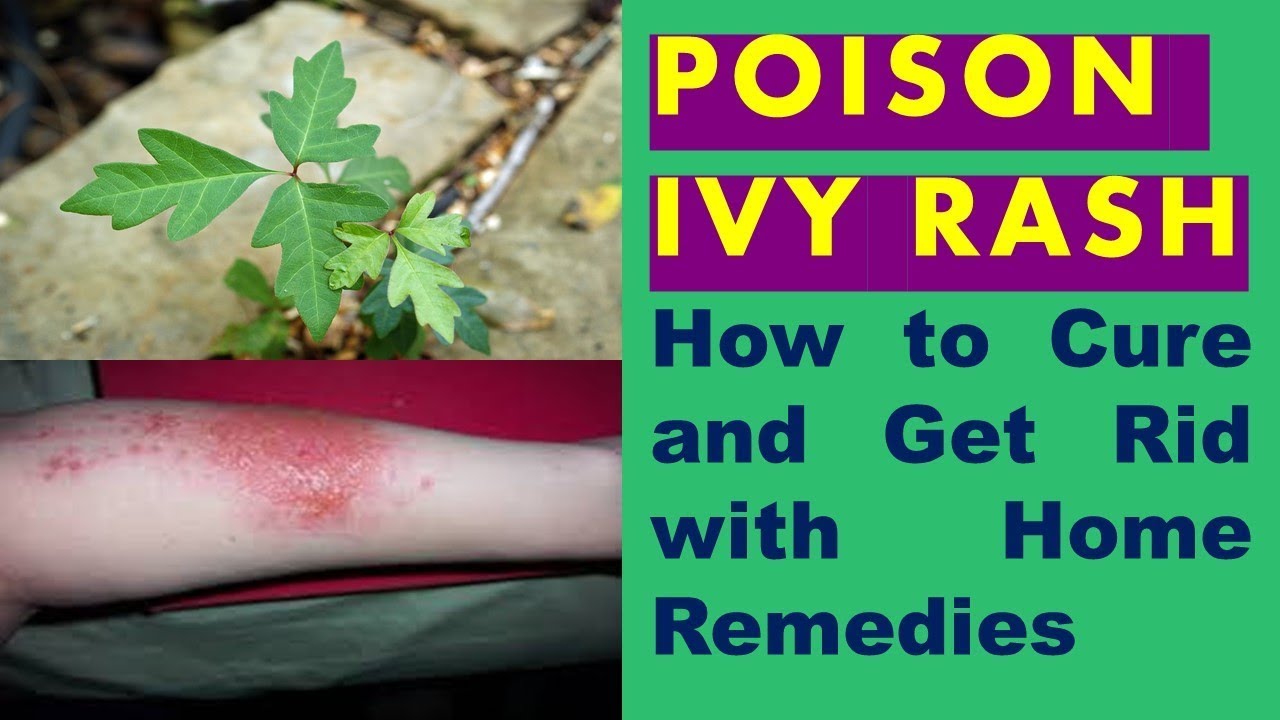 How To Get Rid Of Poison Ivy Rashes Poison Ivy Rash P - vrogue.co