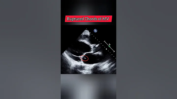 Strings of Mitral Valve visible in LA - Echocardiography for Beginners #Echo #shorts