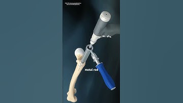 How Tibia Fractures Surgery Is Performed (3D animation) #music #motivation #epic #deformity