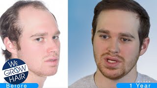 Can a Young Man Get a Hair Transplant?