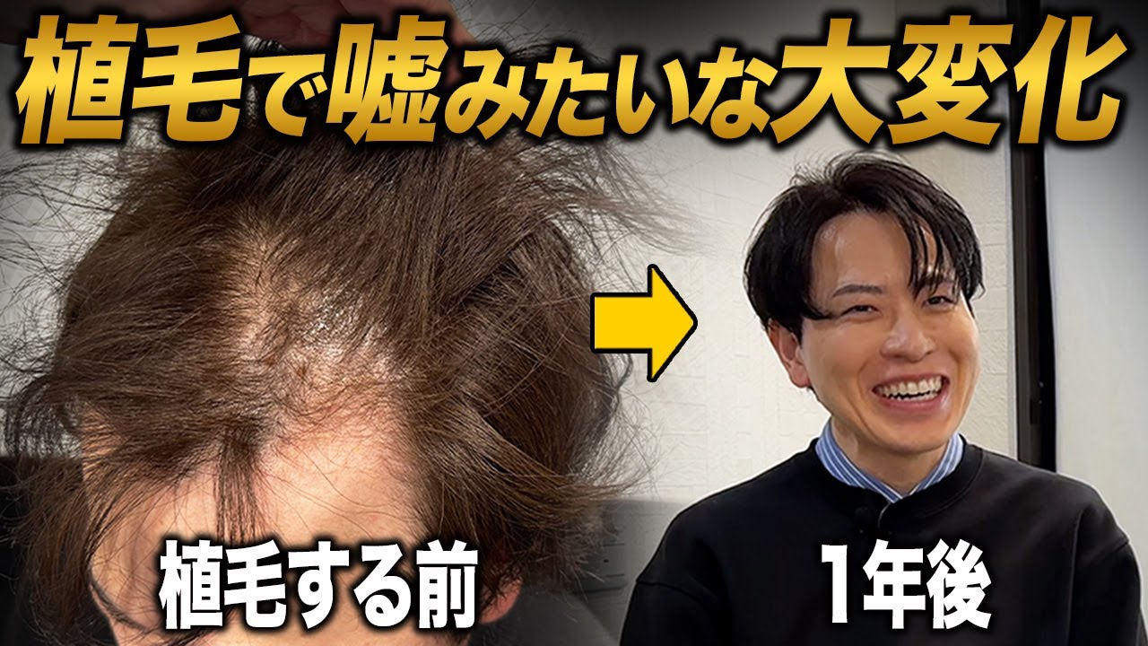 【植毛1年】絶望的だった薄毛はどうなった？この選択は正解だったのか...