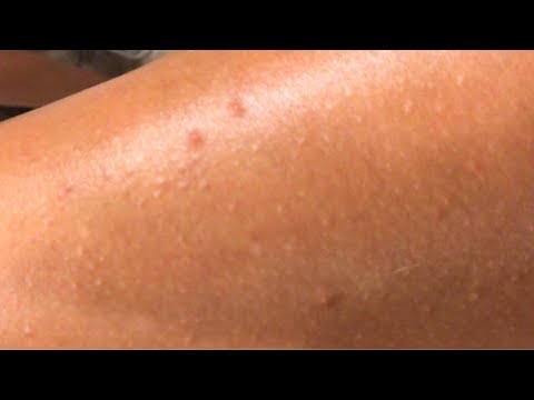 Pimple & Acne Bumps On Skin After Cupping Cellulite.  What Causes Them & Will They Go Away?