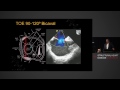 Atrial Septum - Anatomy, Echocardiography & Interventions - A/Prof Gregory Scalia