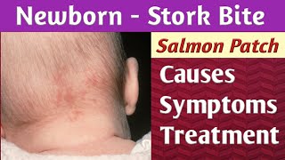 Newborn Stork Bite Salmon Patch Causes, Symptoms, Diagnosis & Treatment